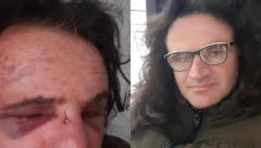 OVAKO IZGLEDA LEPI POSLE BRUTALNOG PREBIJANJA Pevaču cela glava u podlivima i modricama (VIDEO+FOTO)