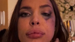 POTRESNO Nataša Šavija otkrila detalje oporavka nakon napada