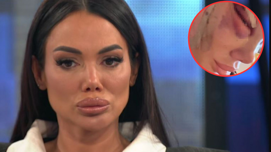 ISPLIVALE JEZIVE FOTOGRAFIJE! Tamara Đurić u modricama, lice joj izobličeno od podliva, javnost uznemirena (FOTO)