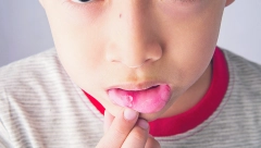 DECI SVUD PO TELU PLIKOVI, IZGLEDA UŽASNO! Pedijatri imaju pune ruke posla zbog virusa koji hara Srbijom, OVO su simptomi!