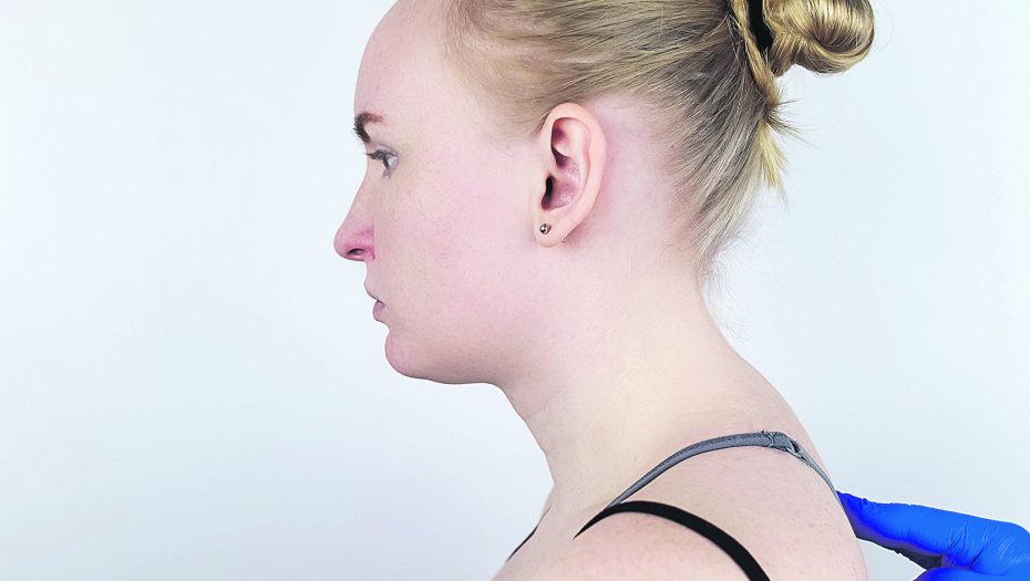 ZDRAVLJE Hormoni moraju da budu u balansu: Odgovori na neka od najvažnijih pitanja u vezi s Kušingovim sindromom