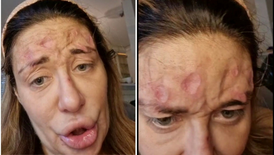 ŠOKANTNI SNIMAK UZNEMIRIO JAVNOST Ani Nikolić se otvorile žive rane po licu, šta joj se dešava? (VIDEO)