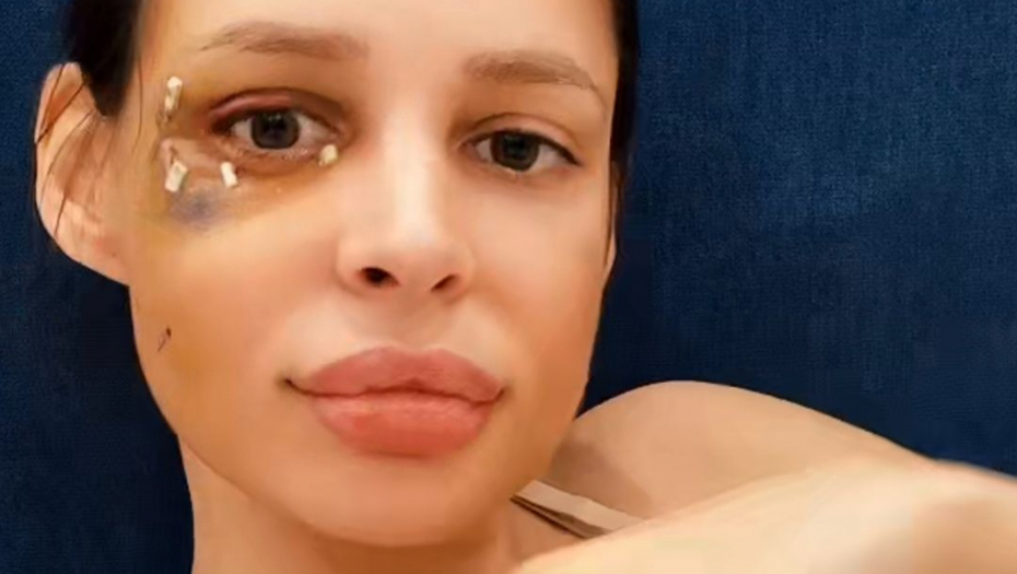 DEFORMISANA SAM ZA CEO ŽIVOT! Nataša Šavija nikad iskrenije o traumi i strahovima
