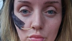 DO KRAJA ŽIVOTA JEŠĆE NA CEVČICU Devojka u Turskoj preživela pakao, za bolji izgled umalo platila glavom jer se "doktor zaneo"