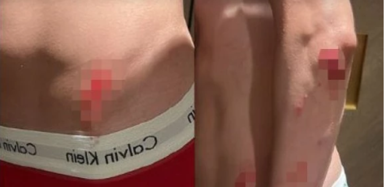 SAV KRVAV, U MODRICAMA I GO! Naš influenser doživeo nezgodu, podelio uznemirujuće fotke povreda! (FOTO)