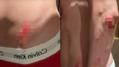 SAV KRVAV, U MODRICAMA I GO! Naš influenser doživeo nezgodu, podelio uznemirujuće fotke povreda! (FOTO)