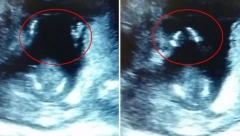 BEBA ČULA MAJKU U STOMAKU, PA POČELA DA RADI NEŠTO NEOBIČNO Neverovatna scena zabeležena ultrazvukom, kako je ovo moguće?