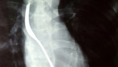 SAD ĆE MORATI DA MU OTVORE STOMAK Dr Arsenijević objavio rendgenski snimak pacijenta, kada su shvatili šta je progutao ostali su u šoku (FOTO)