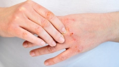 ŠTA IZAZIVA ATOPIJSKI DERMATITIS? Ovo su najveći okidači, izbegnite ih pre nego što bude prekasno