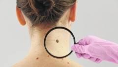 "MOM DETETU JE DIJAGNOSTIKOVAN NEIZLEČIVI RAK NAKON IZLAGANJA SUNCU" Evo koji su bili prvi simptomi opake bolesti