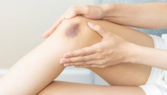 DA LI SU MODRICE OPASNE? Najčešći razlozi za njihovu pojavu po telu, evo kada treba da se javite lekaru