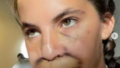 UNAKAŽENO LICE I 10 OPERACIJA Na devojku skočio PITBUL i otkinuo joj gornju usnu i deo nosa, evo kako sada izgleda (FOTO)