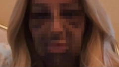 LJUDI SU JOJ SE SMEJALI NA ULICI Ženi stomatolog UNAKAZIO LICE, sva je u modricama i podlivima (VIDEO)