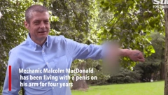 ČOVEK OSTAO BEZ POLNOG ORGANA ZBOG INFEKCIJE Presadili su mu ga NA RUKU i ovako živi već šest godina (VIDEO)