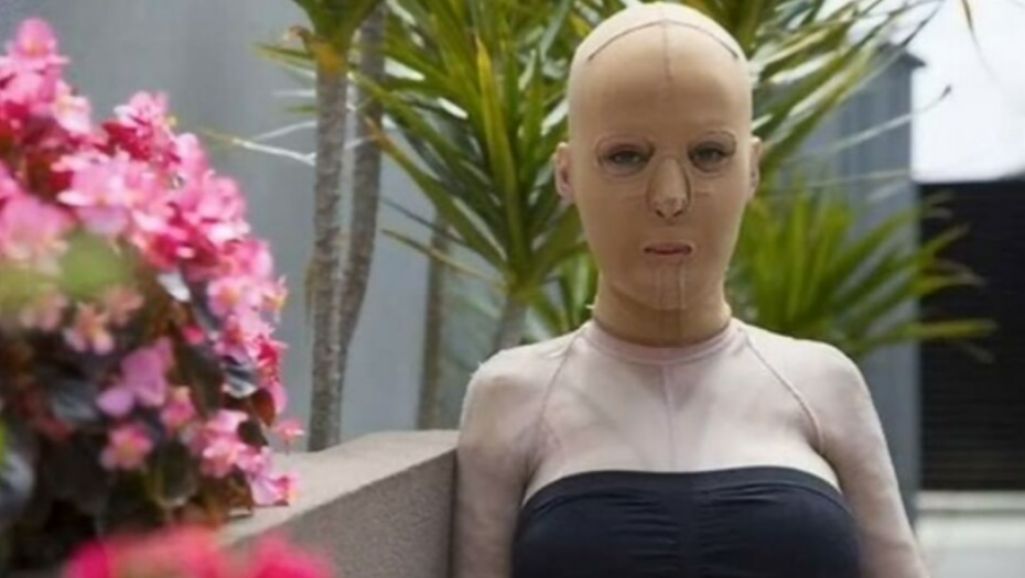 POSLE 200 OPERACIJA OVAKO DANAS IZGLEDA Lepu Danu je ljubomorna žena ŽIVU SPALILA (FOTO)