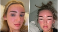 OVAKO IZGLEDA TROVANJE SUNCEM, A SIPMTOMI SU ALARMANTNI: Fotografije će vas zastrašiti!