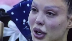 "HIRURG JOJ JE GREŠKOM SILIKONE ZA GRUDI STAVIO U ZADNJICU" Majina pozadina se potpuno izdeformisala, isplivale šokantne slike