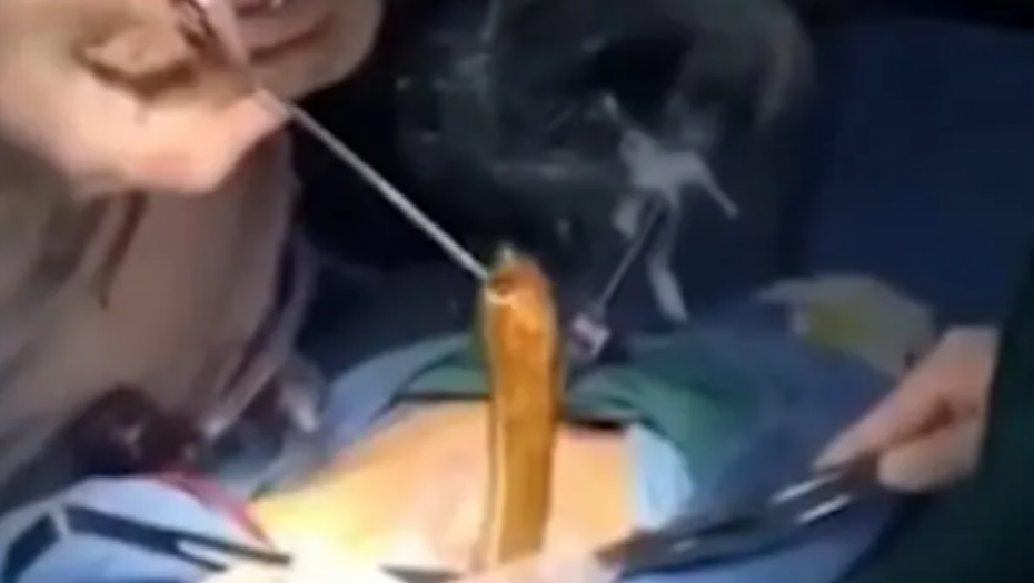 ČOVEKU U STOMAKU PRONAŠLI ZALUTALO BIĆE Doktori ostali u ŠOKU kada im se pred očima stvorila ONA (VIDEO)
