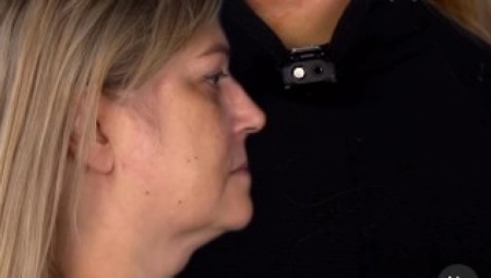 SA 52 GODINE, LANA JE ŽELELA DA PONOVO IZGLEDA KAO SA 18 Hirurgu je donela jednu jedinu fotografiju. Pogledajte njen novi izgled (UZNEMIRAVAJUĆI VIDEO)