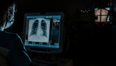 MUŠKARAC OSETIO DA MU NEŠTO PUZI NIZ GRLO Snimak otkrio odvratnog insekta u plućima, da se naježiš!