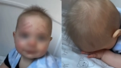 MAJKA NA BEBINOM LICU ZATEKLA CRVENE TRAGOVE Ono šta je otkrila da se krije iza ovoga svi komentarišu