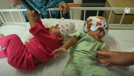 BLIZNAKINJE ROĐENE SA SPOJENIM GLAVAMA Na njihovom razdvajanju radilo je 60 lekara, operacija je bila dramatična! (VIDEO)