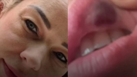 EDITA JE OTIŠLA NA KOREKCIJU USANA FILERIMA Ono što su lekari otkrili bukvalno joj je spasilo život