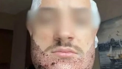 STUDENT SE UBIO ZATO ŠTO MU JE LAŽNI HIRURG UNAKAZIO LICE! Operacija ga koštala 1.300 evra!