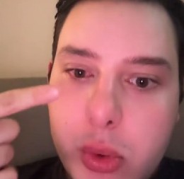 OBIČNO STAVLJANJE SOČIVA SE PRETVORILO U HOROR Influenser iz Bosne umalo ostao bez oka - zastrašujuće! (VIDEO)