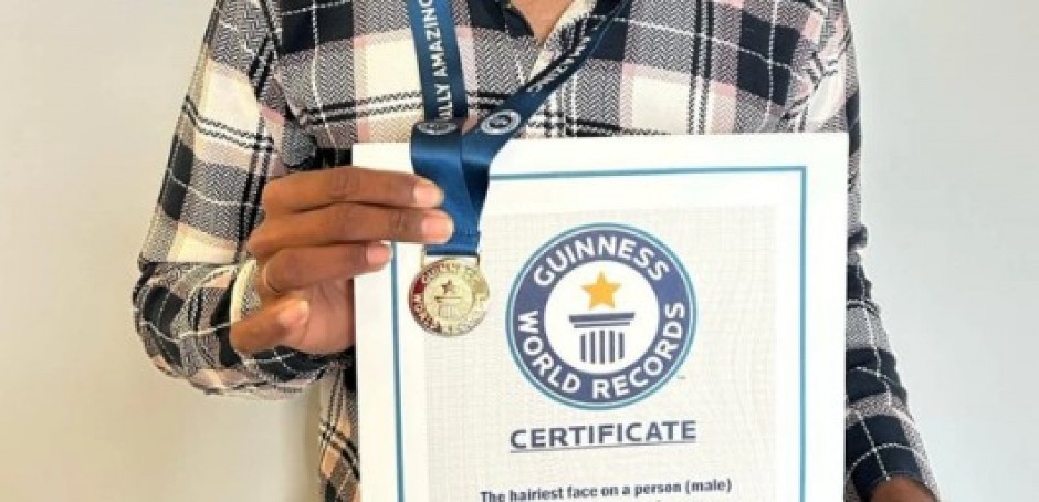 LJUDI SU BEŽALI OD NJEGA, A DANAS JE SVETSKA ZVEZDA Šokantna priča najdlakavijeg dečaka na svetu, evo kako danas izgleda (FOTO)