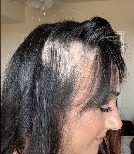 ŽENA JE BILA OČAJNA, JER JE MALTENE OĆELAVILA Promenila je ishranu i kosa je izrasla ponovo za 2 meseca!