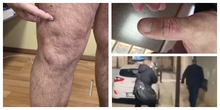 OVAKO SADA IZGLEDAJU RANE DIREKTORA DOMA ZDRAVLJA U NIŠU NAKON JEZIVOG MARTOVSKOG NAPADA! (FOTO)