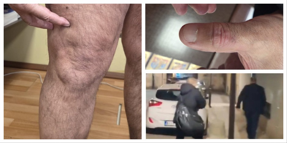 OVAKO SADA IZGLEDAJU RANE DIREKTORA DOMA ZDRAVLJA U NIŠU NAKON JEZIVOG MARTOVSKOG NAPADA! (FOTO)