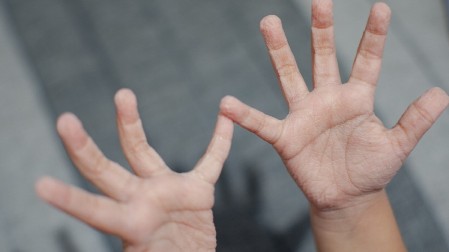 ŠTA ZNAČi AKO VAM OTIČU RUKE I PRSTI? Zaobljeni vrhovi prstiju mogu biti rani znak upozorenja na ovu bolest