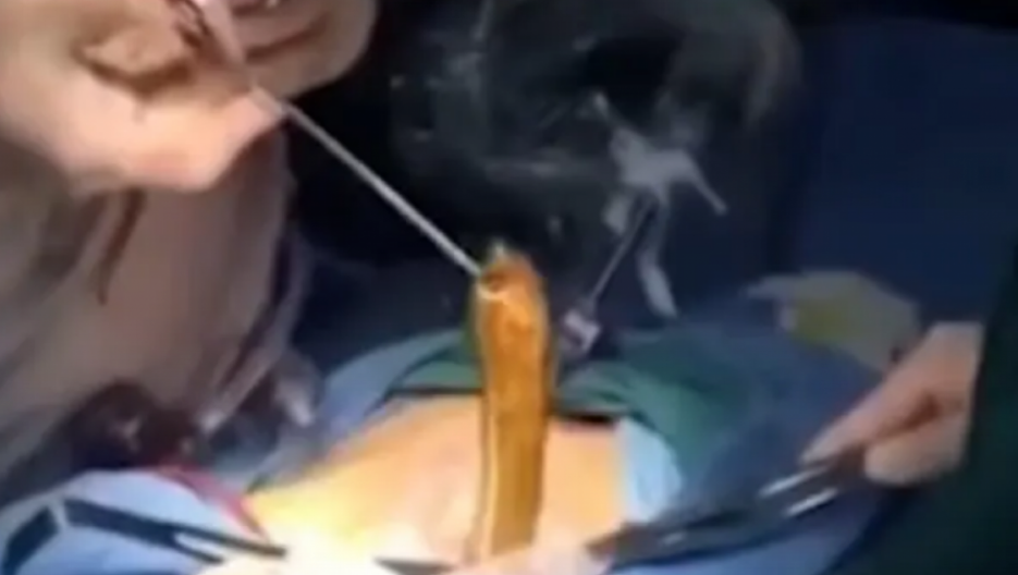 NAŠLI MU JEZIVO BIĆE U STOMAKU Doktori ostali u ŠOKU kada im se pred očima stvorila ONA (VIDEO)