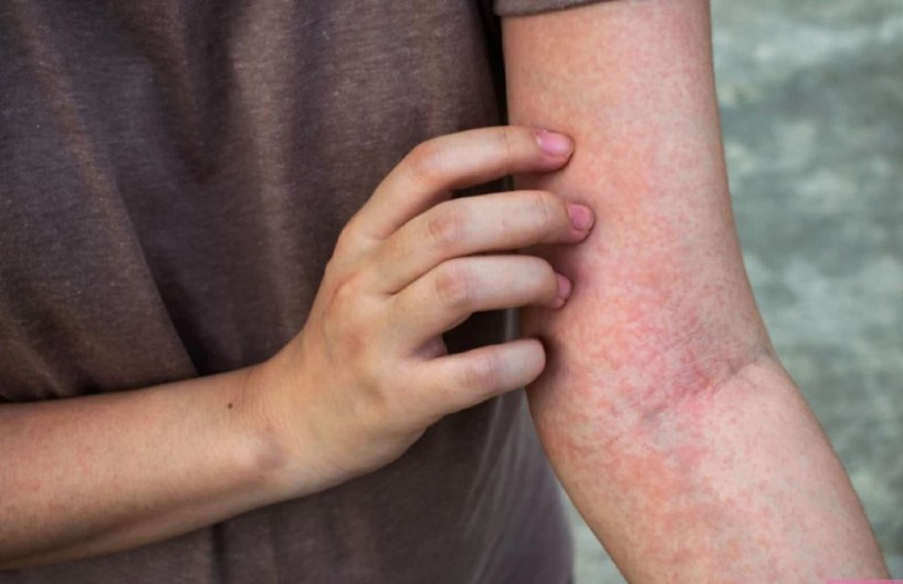 JULIJANI SE POJAVIO OSIP I MISLILA JE DA JE BEZAZLEN U roku od 15 minuta bila je na ivici smrti, lekari su je jedva spasli