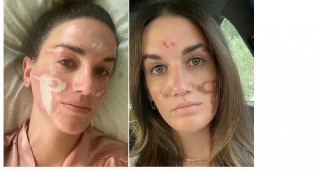 SPALJIVALA MI JE LICE, VRIŠTALA SAM OD BOLOVA! Poznata kozmetičarka me unakazila, pazite gde idete, ožiljci ostaju zauvek