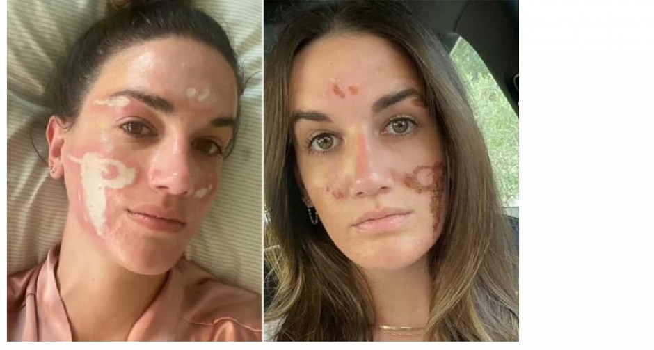 SPALJIVALA MI JE LICE, VRIŠTALA SAM OD BOLOVA! Poznata kozmetičarka me unakazila, pazite gde idete, ožiljci ostaju zauvek