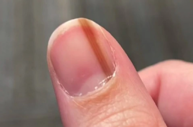 10 GODINA SAM MISLILA DA JE LINIJA NA MOM NOKTU OBIČAN BELEG Iza svega se krila jeziva istina, jedan doktor mi je spasio život