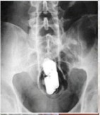 STARIJA ŽENA U INTIMNOM DELU PRENOSILA HEROIN "Niko nije očekivao da žena od skoro 60 godina narkotike krije u polnom organu"