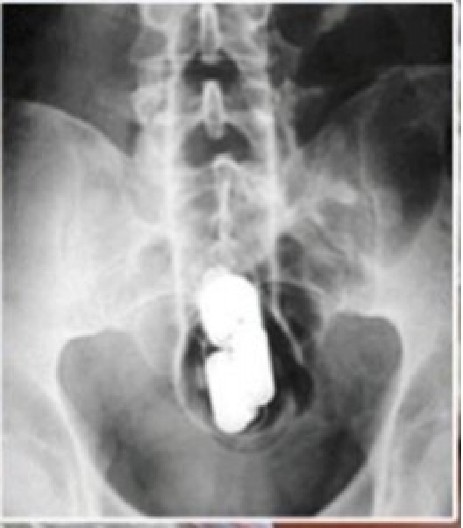 STARIJA ŽENA U INTIMNOM DELU PRENOSILA HEROIN "Niko nije očekivao da žena od skoro 60 godina narkotike krije u polnom organu"