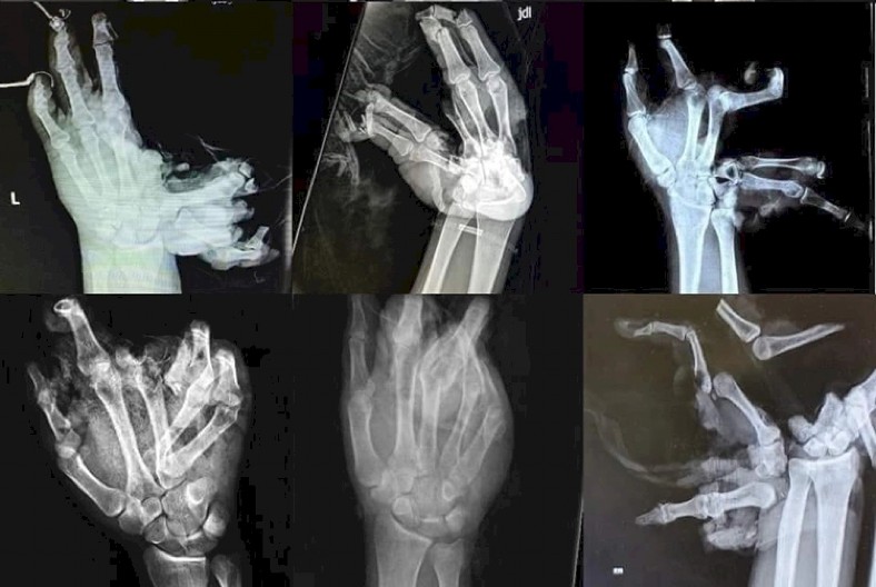 UŽAS U BARAJEVU Dečaku (10) eksplodirala petarda u šaci, tinejdžeru (15) plastični hirurzi operisali obe ruke!