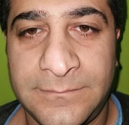 NI ROĐENA MAJKA NE MOŽE DA IH PREPOZNA Plastični hirurzi u Turskoj menjaju ljudima lični opis, kakav šok! (FOTO)