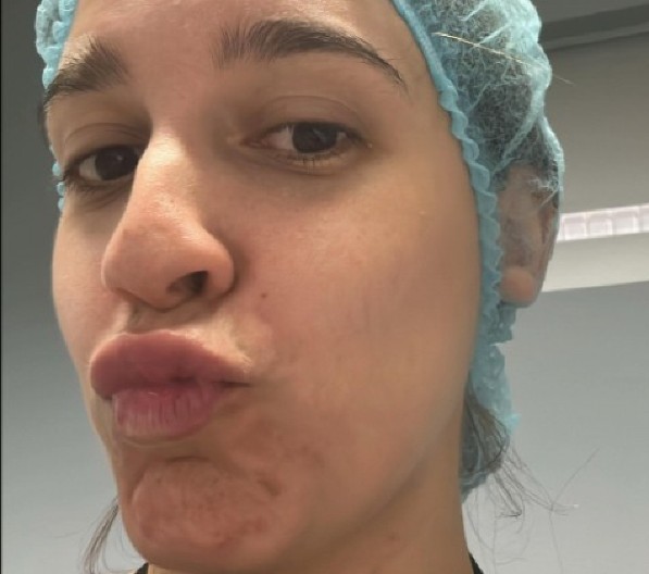 HOROR ZBOG UKLANJANJA FILERA Pogledajte lice influenserke koje je obišlo svet – NIKO nije bio spreman na ovo! (FOTO)