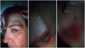 NISU MOGLI DA PADNU NIŽE! Blokaderi su Danijelu u Nišu pogodili kamenicom u glavu, da li je ovo zaslužila jedna majka i baka?! (FOTO)