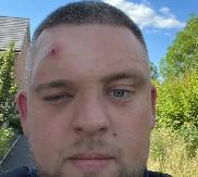 NEŠTO MU JE ISKOČILO IZ ČELA I KRENULO DA SE KOPRCA Mislio da je obična bubuljica, a onda su mu lekari mu saopštili šokantnu dijagnozu! (VIDEO)