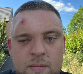 NEŠTO MU JE ISKOČILO IZ ČELA I KRENULO DA SE KOPRCA Mislio da je obična bubuljica, a onda su mu lekari mu saopštili šokantnu dijagnozu! (VIDEO)