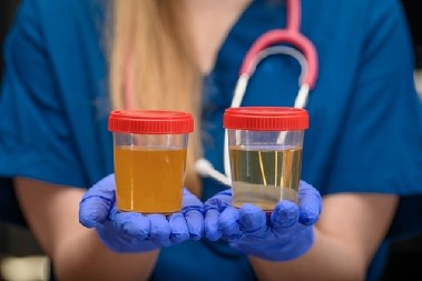 DA LI JE TAMAN URIN OPASAN?  Evo šta ova boja mokraće govori o vašem zdravlju