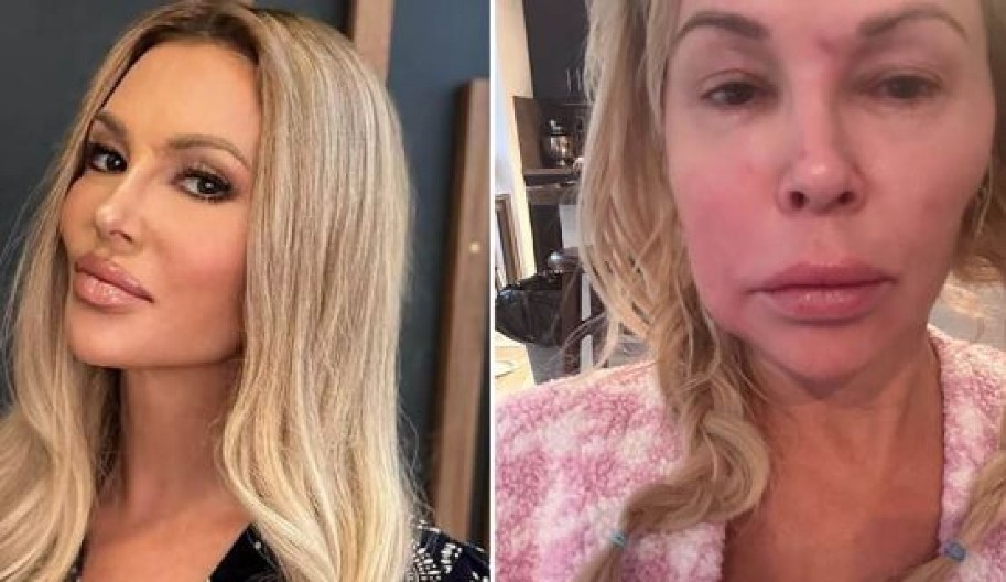 BIVŠA RIJALITI ZVEZDA PREŽIVLJAVA HOROR Parazit joj razjeda lice, pokušala da ga ‘spali’ kremom za depilaciju