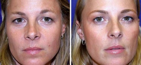 BRIŠE BORE BOLJE OD BOTOKSA Napravite savršenu masku za lice i prirodnim putem zategnite kožu